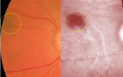 Choroidal Naevi Breakthrough: Navigating Success with Hyperspectral Imaging Studies